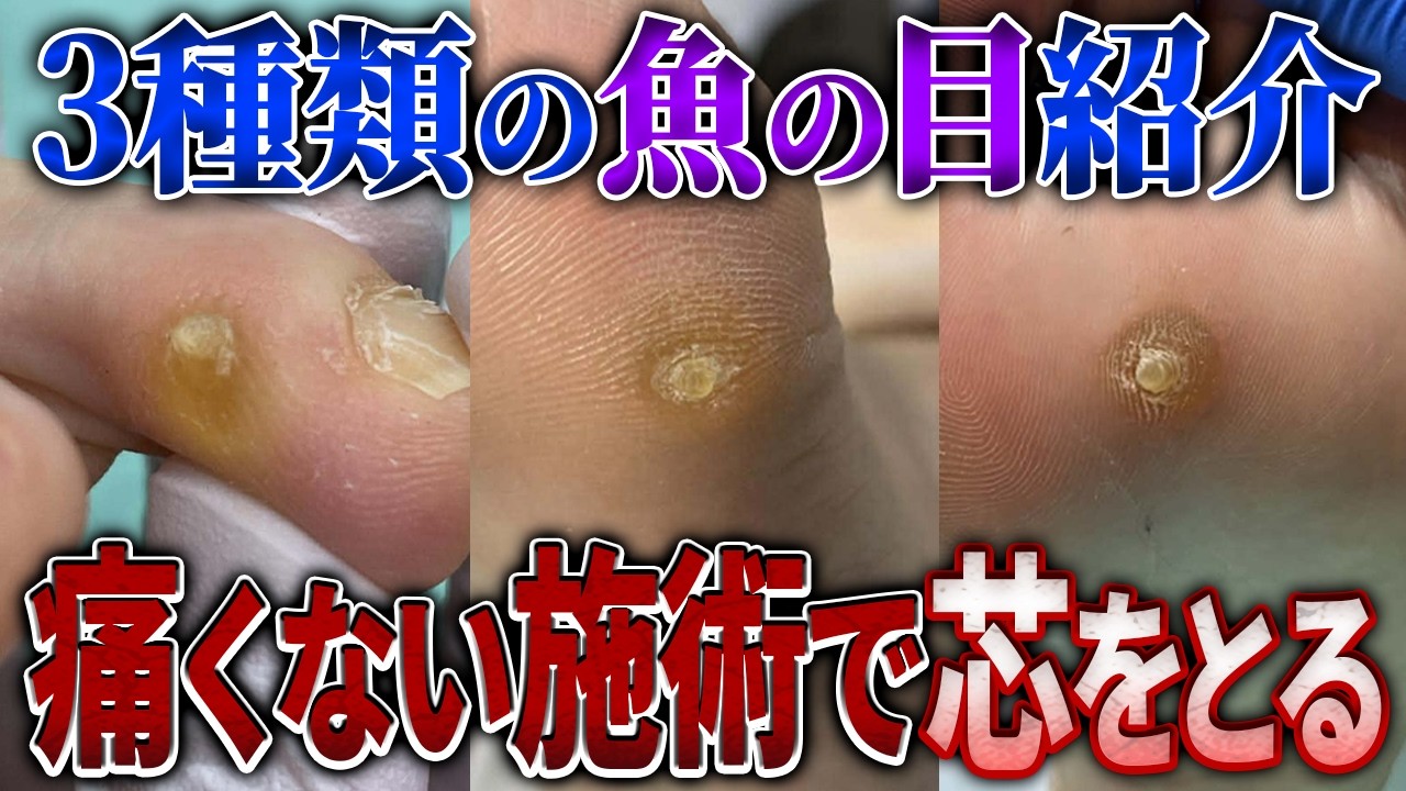 【BeforeAfter】様々な魚の目をご紹介！魚の目はできやすい場所があります！