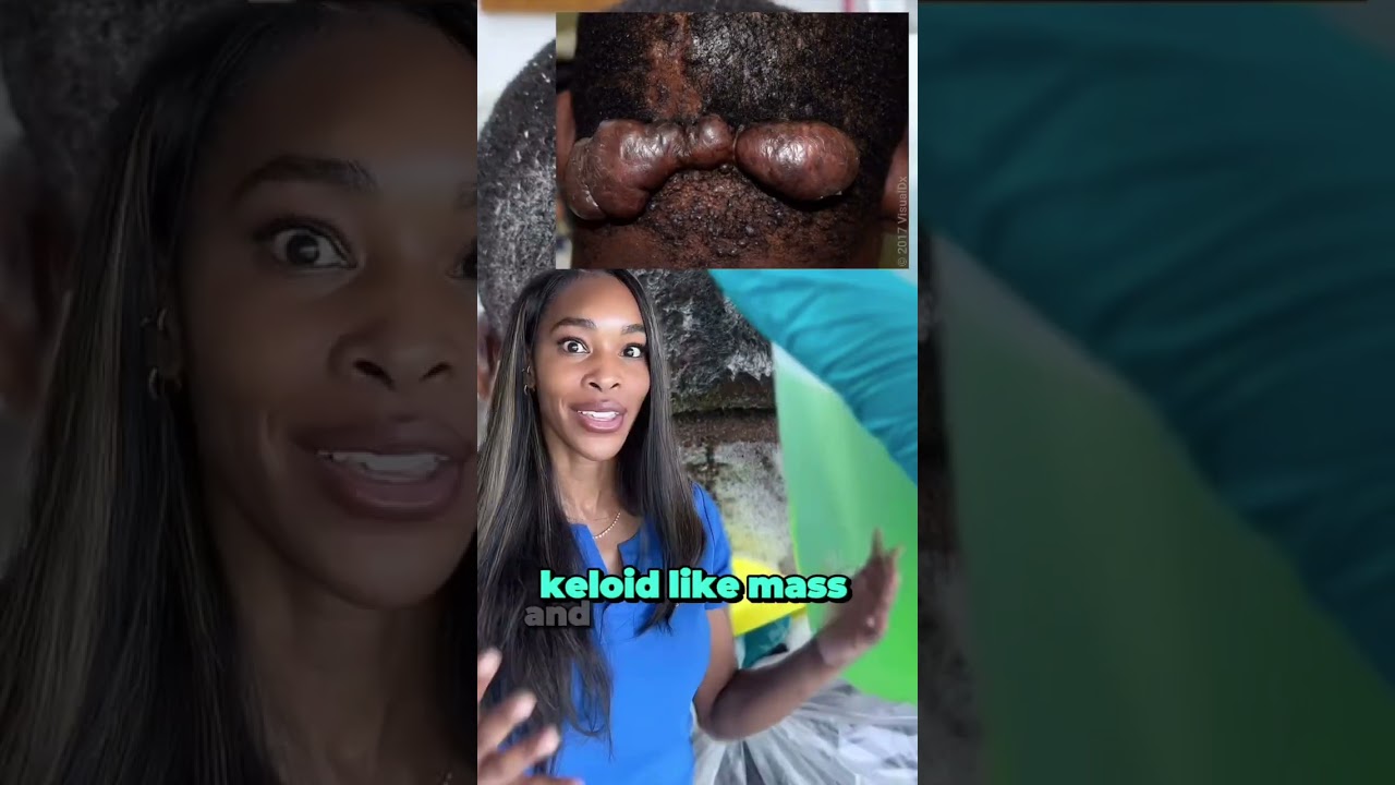 Not Razor Bumps: What You Need to Know About AKN