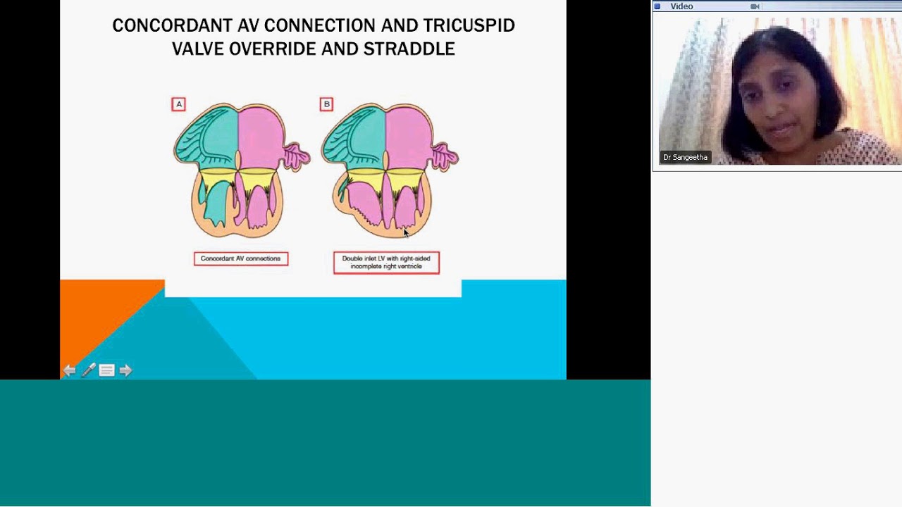 Pedicardio classes on DILV  by Dr Sangeeta Viswanathan