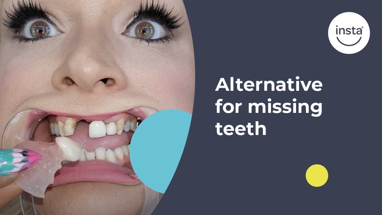 Denture Alternative for Missing Teeth | Instasmile Review