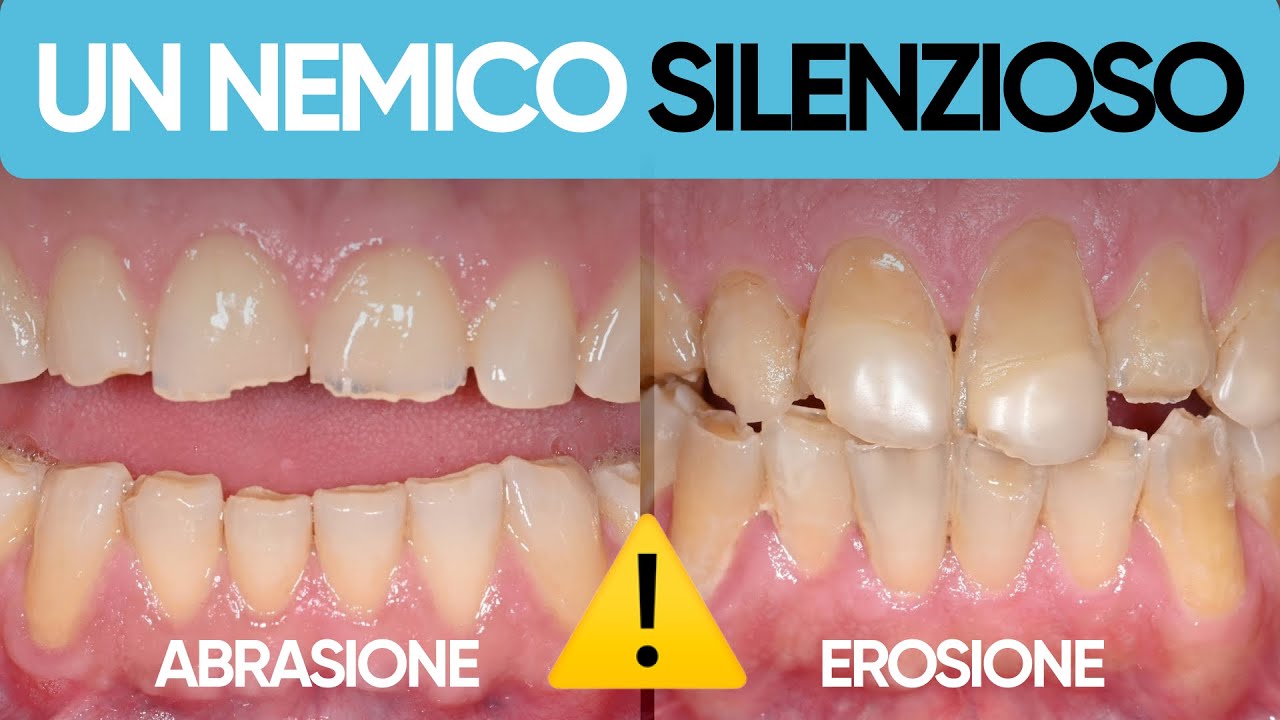 3 modi silenziosi con cui PUOI PERDERE i tuoi denti (non è la carie)