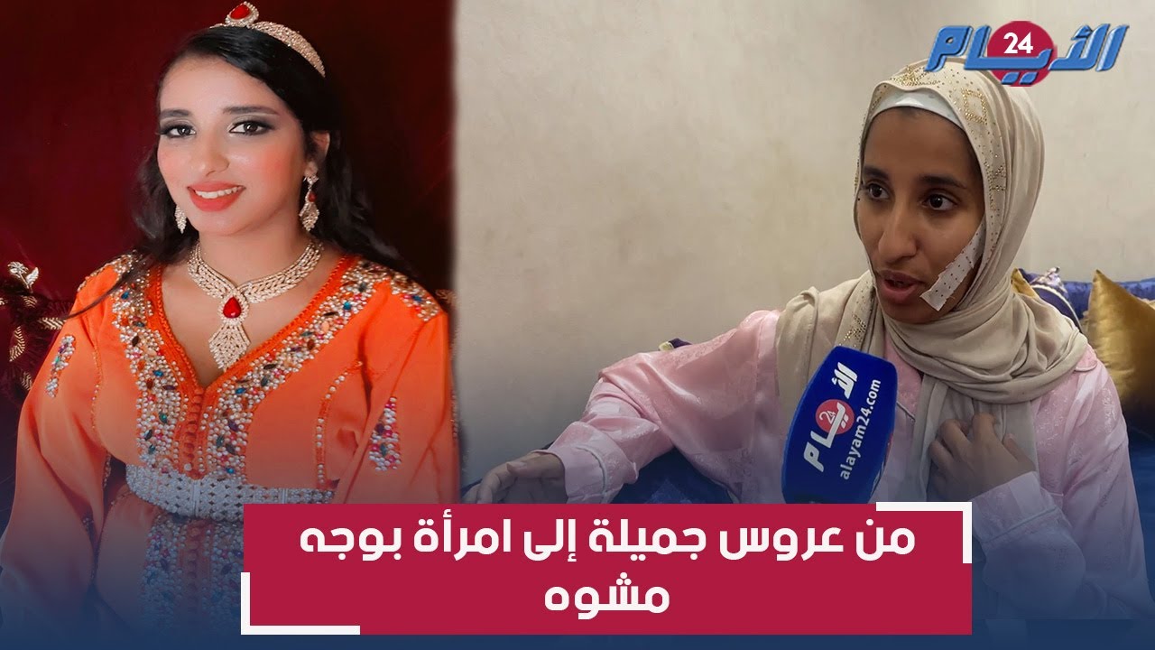بعد شهرين من الزواج.. رجاء بوجه مشوه وقصتها ستهز المغاربة