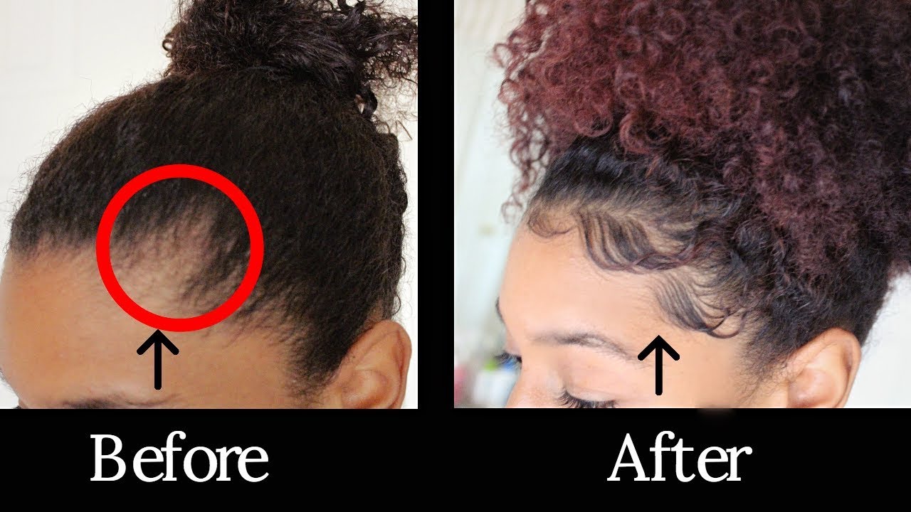 Thinning Edges & Bald Spot ( How to Quickly Regrow & Prevent )