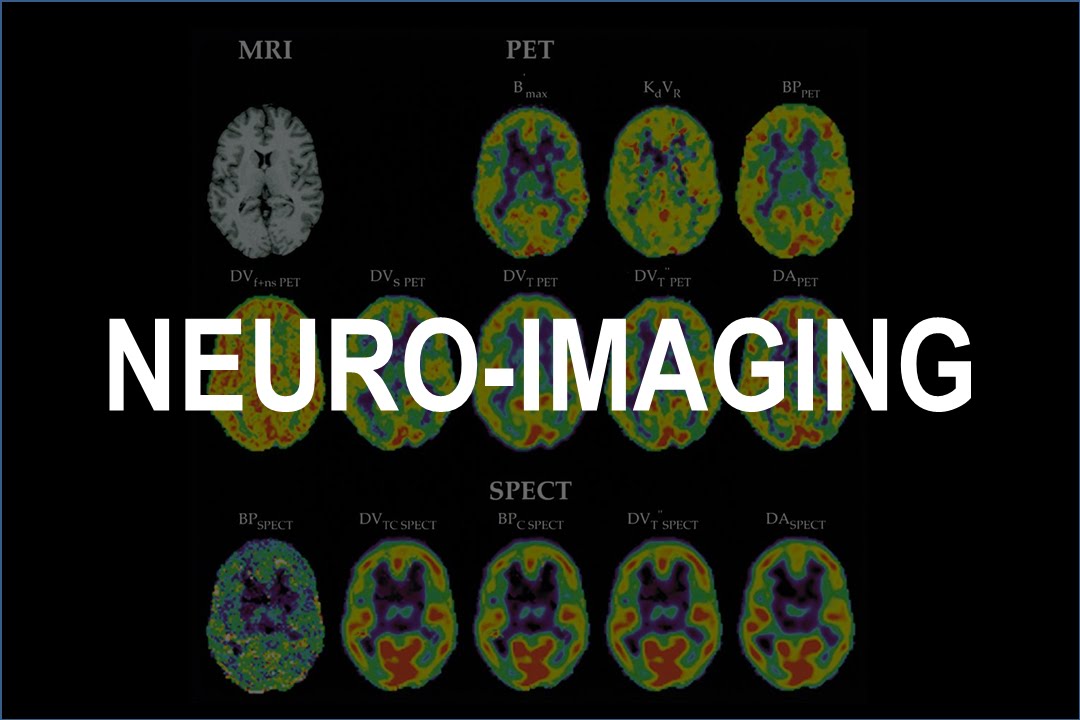 Dissociative Disorders in Psychiatry & Medicine [Part 6] - Neuroimaging - Dr Frans J. Cronje