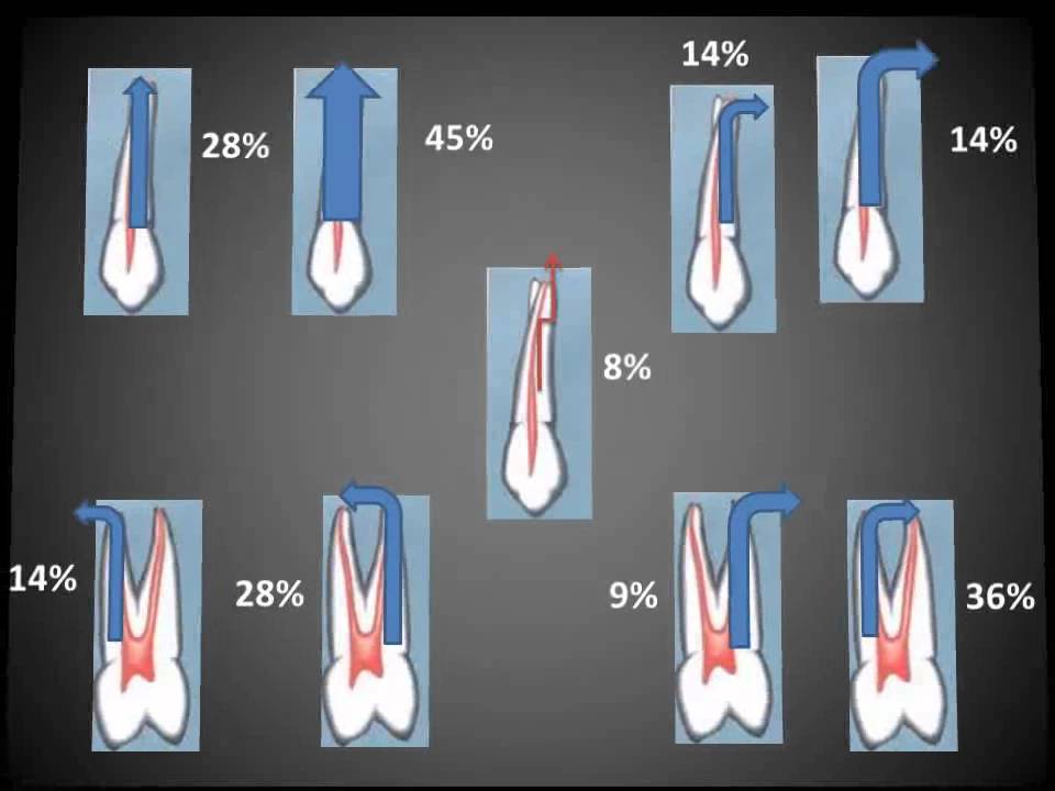 Primer premolar superior.wmv