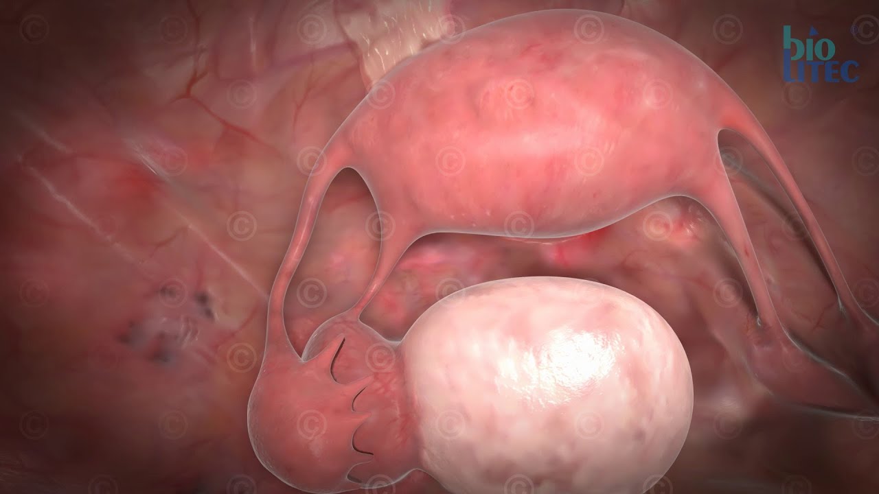 3D Animation gyn&auml;kologische Operation