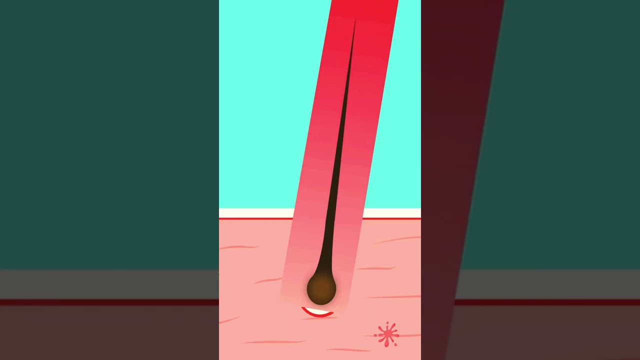 laser hair removal, from a hair follicle perspective