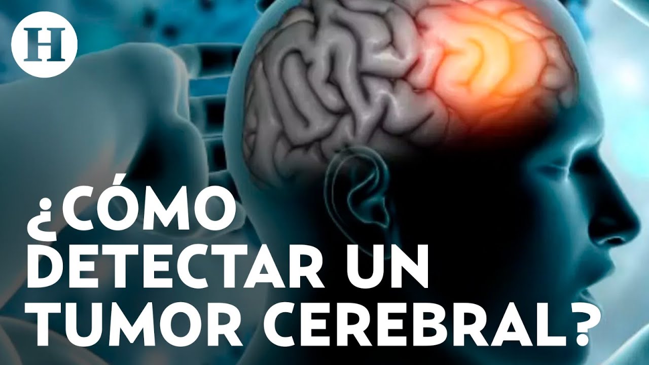 ¿Te duele la cabeza continuamente? ¡Cuidado! Podrías tener un tumor cerebral, detecta los síntomas