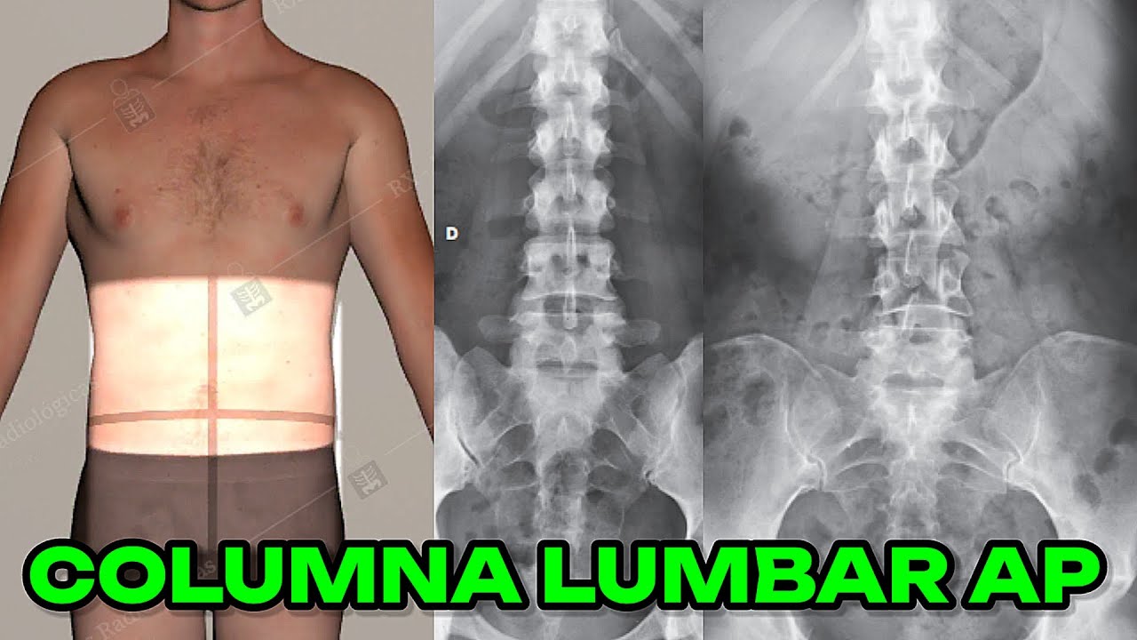 RADIOGRAFÍA DE COLUMNA LUMBAR AP (MANUAL DE BOLSILLO) #28