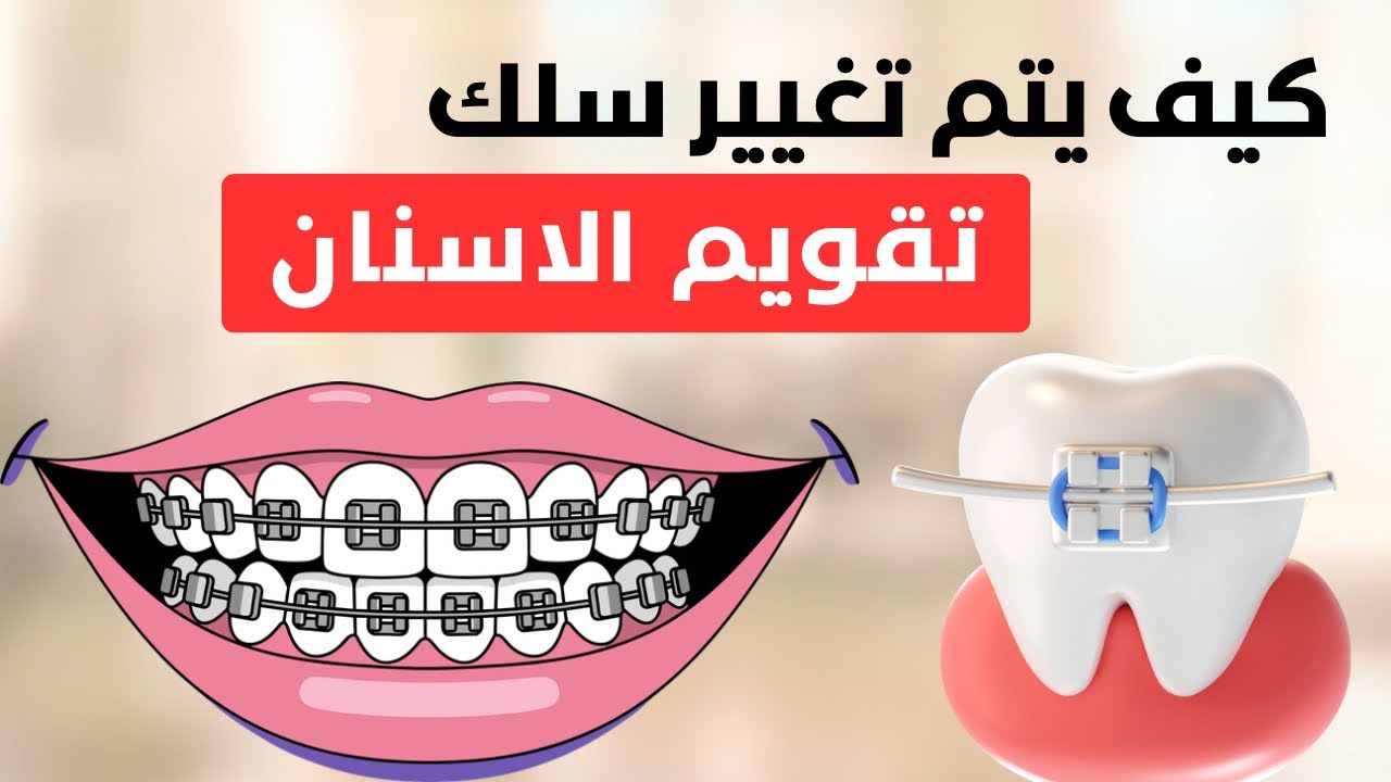 تغيير واير تقويم الأسنان 