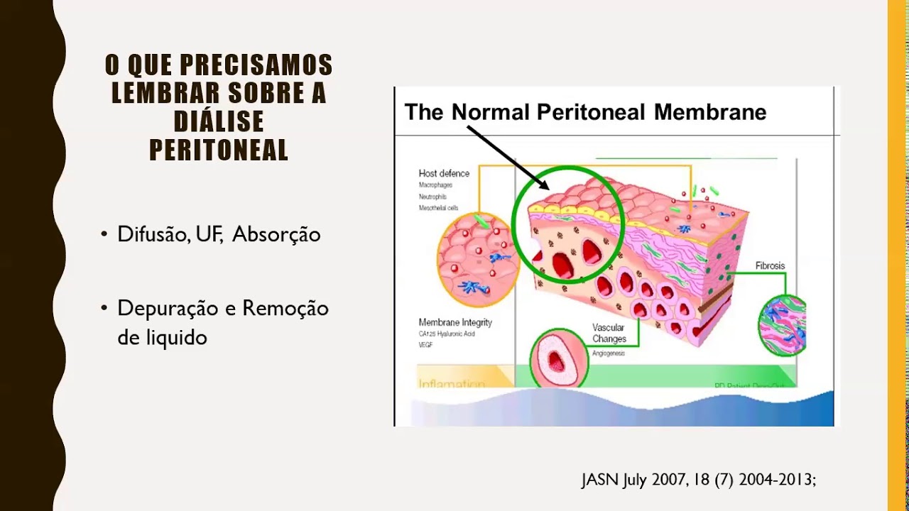 Dialise Peritoneal na Lesão Renal Aguda - Drª Vanessa Marasca