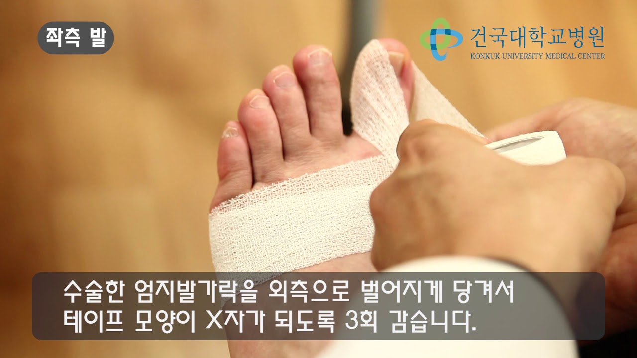 족부족관절 운동법 - 무지 외반증 테이핑 방법