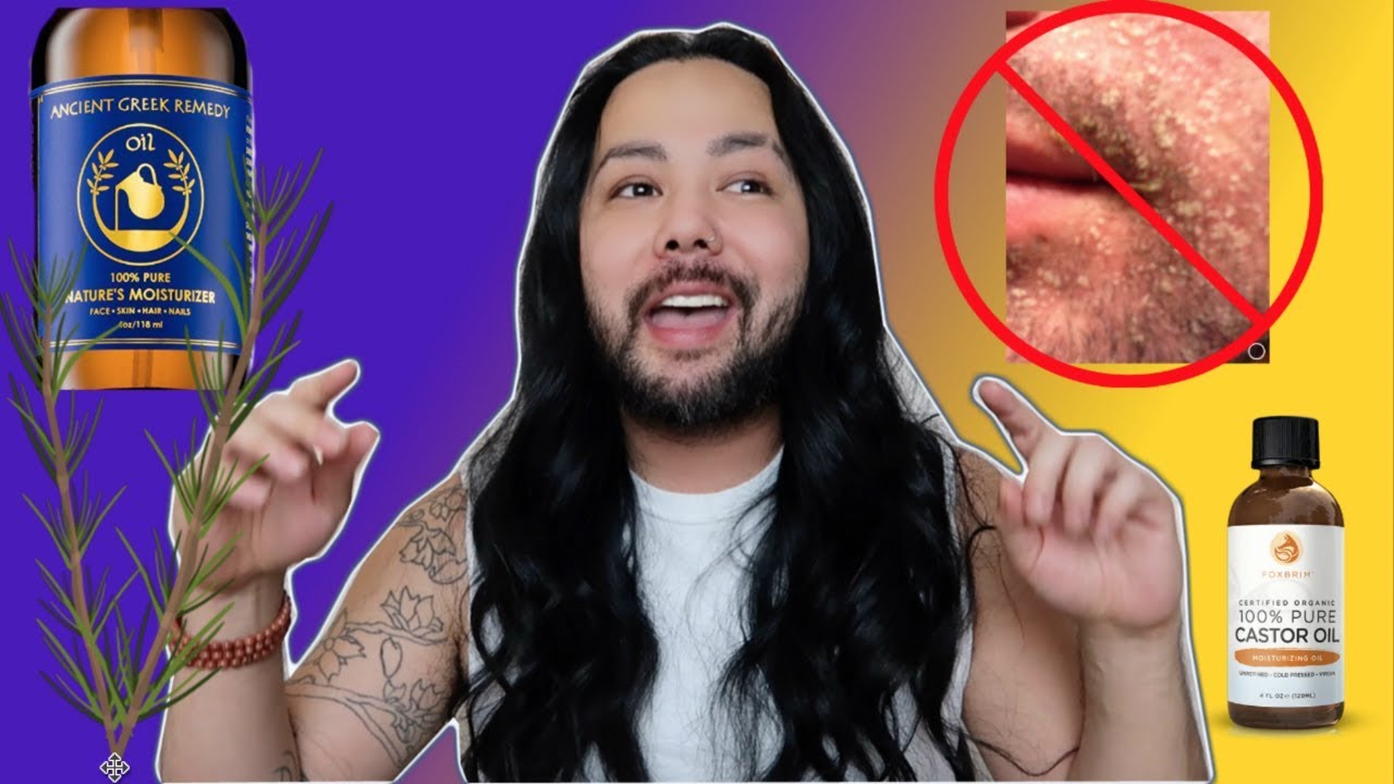 How I treat my Face|Scalp Psoriasis Seborrheic Dermatitis natural home remedies