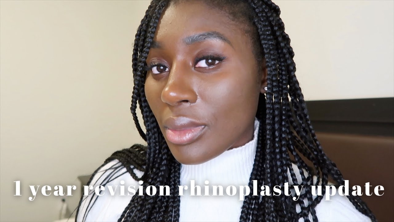 1 YEAR REVISION RHINOPLASTY UPDATE 👃🏾 | Dr. Emrah Celik