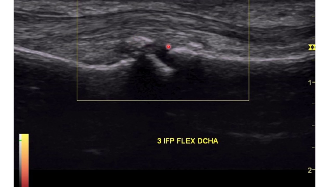 Generalidades de la sonoanatomia musculoesquelética