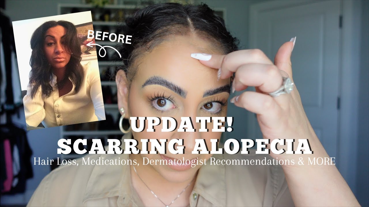 UPDATE On My SCARRING ALOPECIA | MORE Hair Loss, Medications & Dermatologist Recommendations