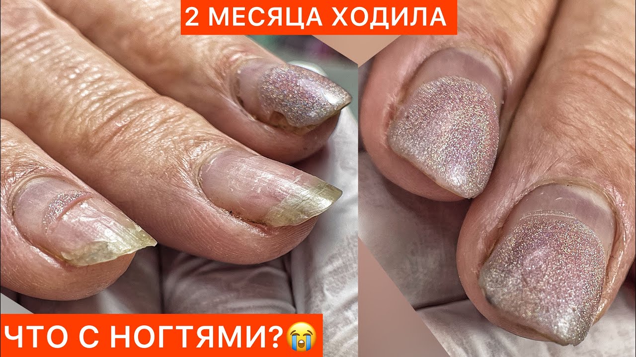 СРОЧНО🚨 ОТСЛОЙКИ С ТОРЦА🤬ДЕЛАЙ ТАК И ПРОБЛЕМЫ УЙДУТ