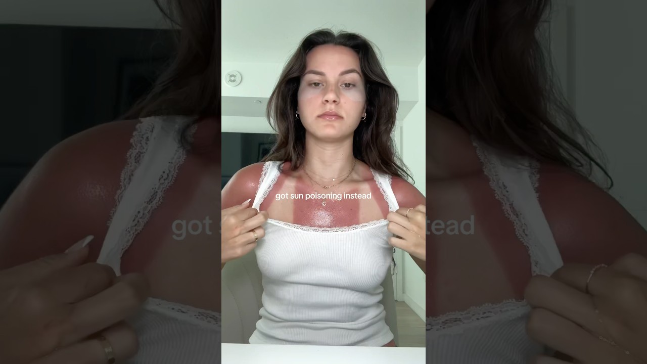 wanted to feel something #sunburn #summer #sun #sunpoisoning #skincare #skin #burn #miami #florida