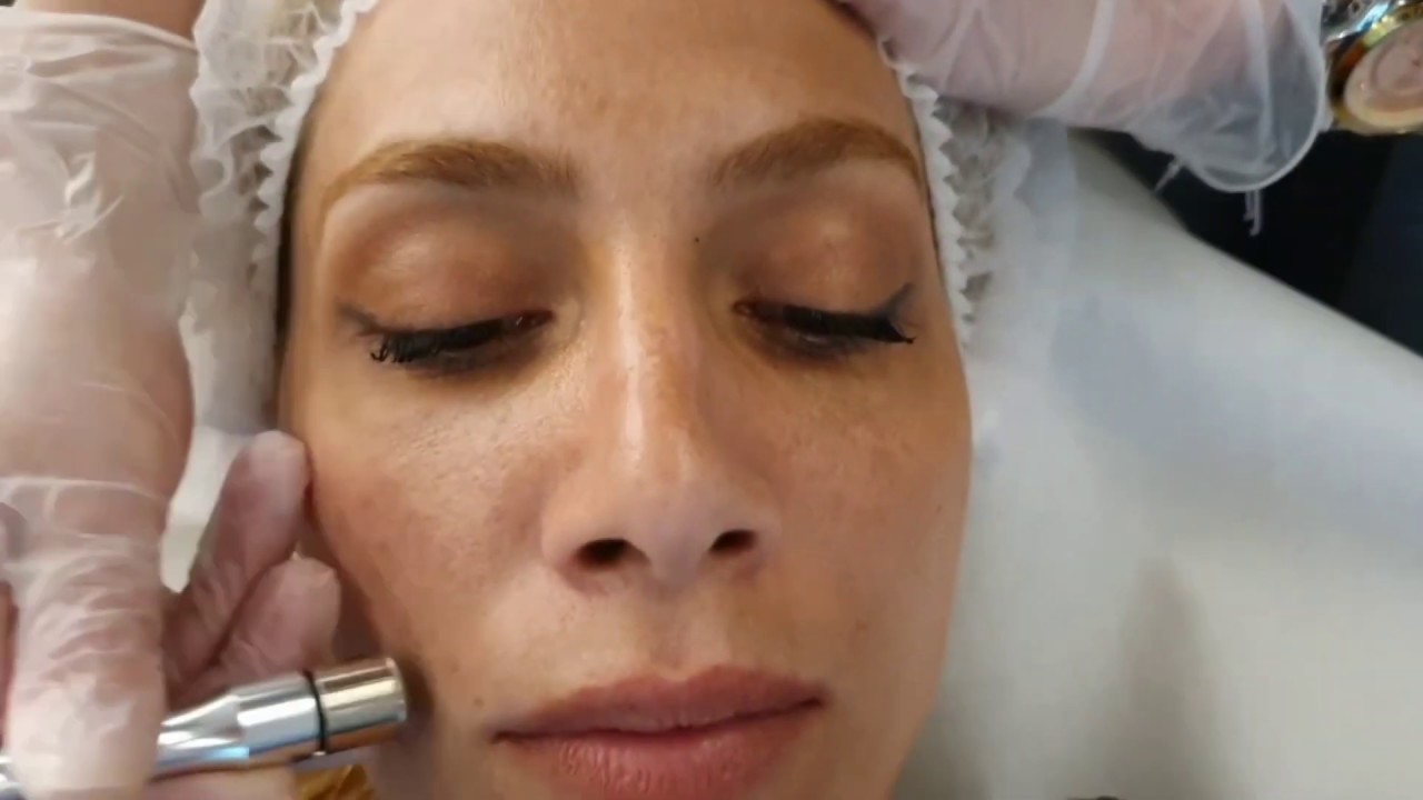 Skin Centers - Θεραπείες Προσώπου - Πώς γίνεται η Δερμοαπόξεση με Διαμάντι
