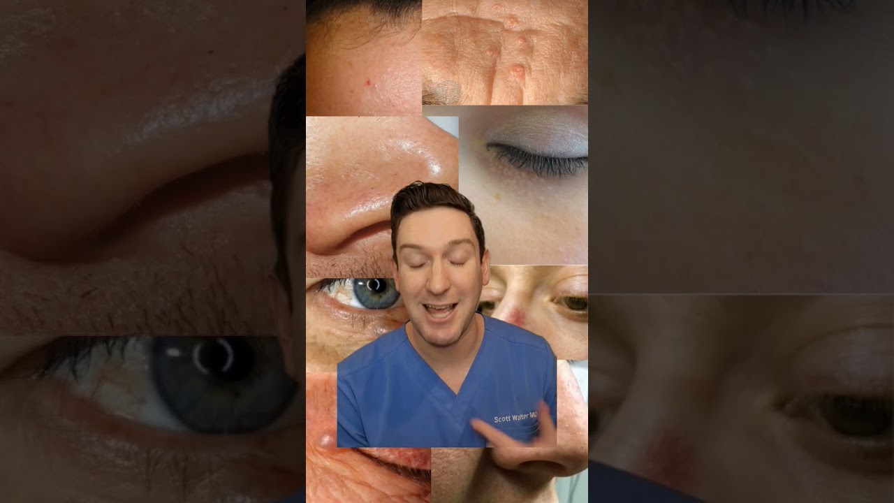 What's that on your face? dermatologist explains fibrous papules #fibrouspapule #derm #nosebump