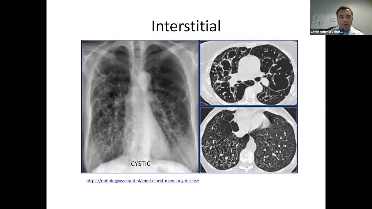 Radiographic findings in COVID