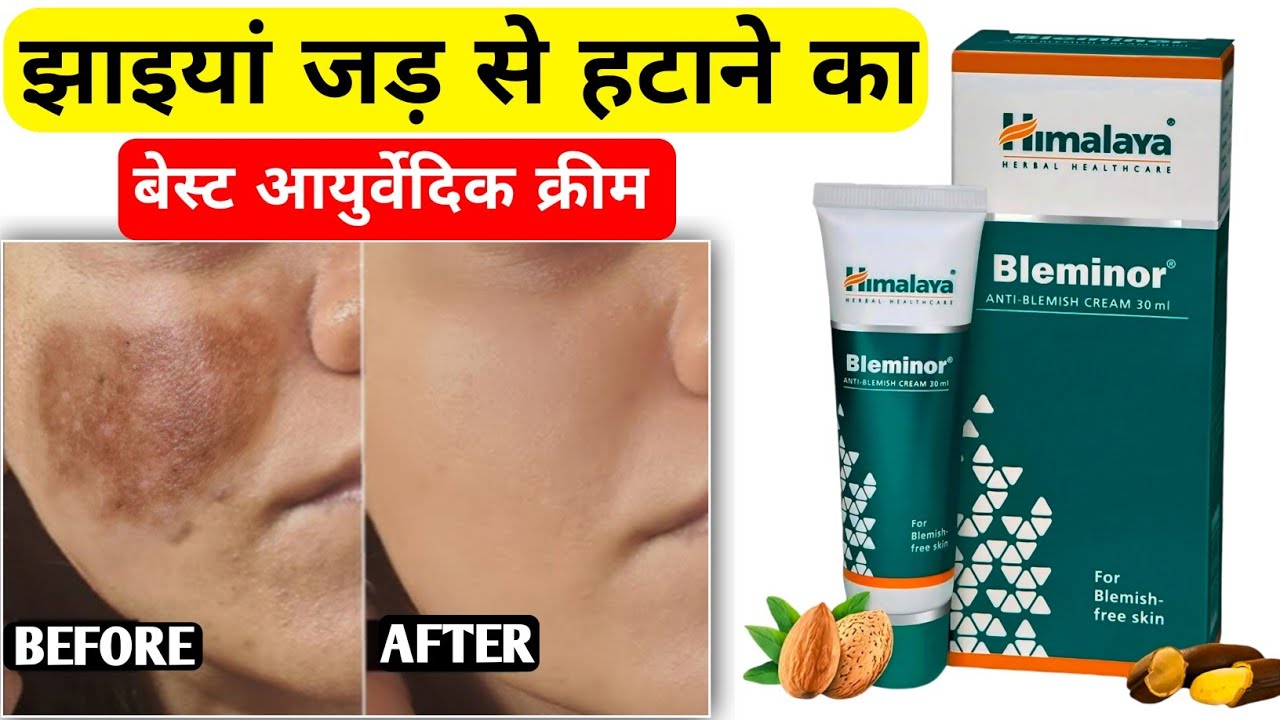 झाइयां खत्म करने की क्रीम | Bleminor Cream Himalaya Review | Jhaiya Khatam Karne Ki Cream