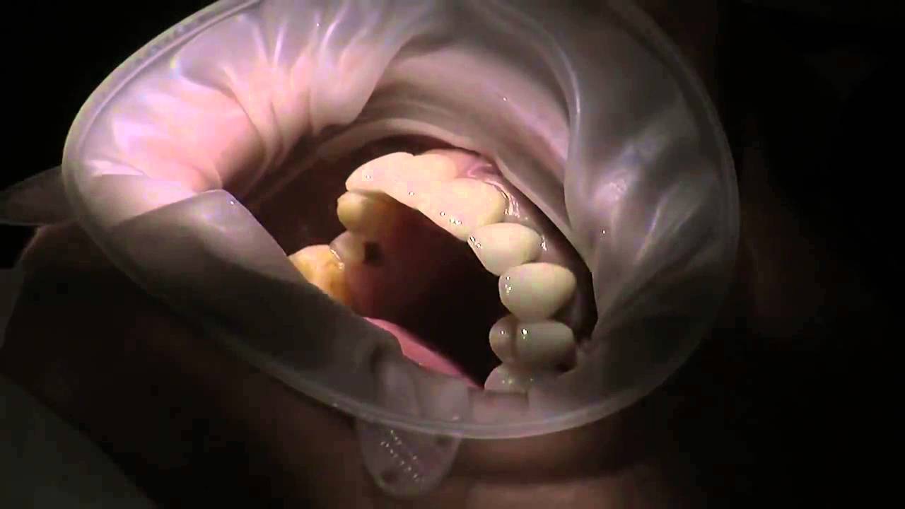 Smile make over with Dr  Parmar  Episode 14  try in of restorations