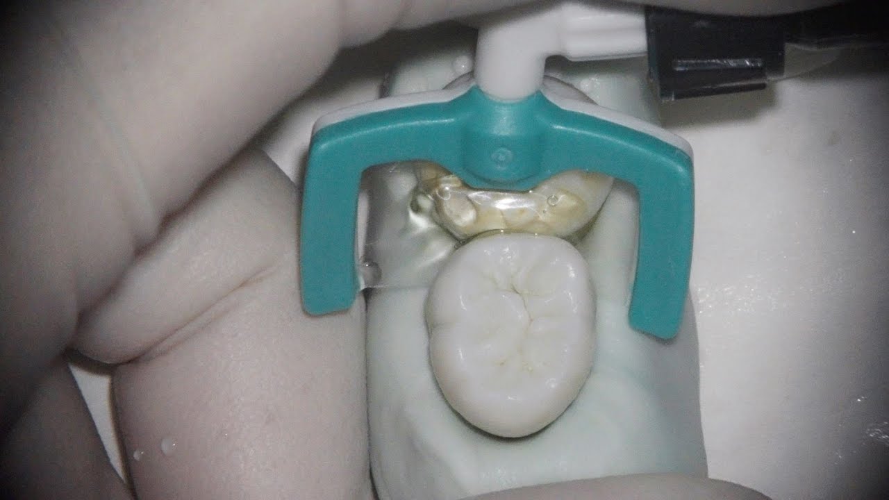 Proximal Resin Infiltration - ICON (hand on)