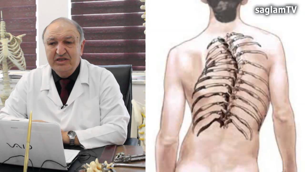 saglamTV. Professor Yaşar Celilov. Yashar Jalilov. Skoliozun müalice prinsipleri