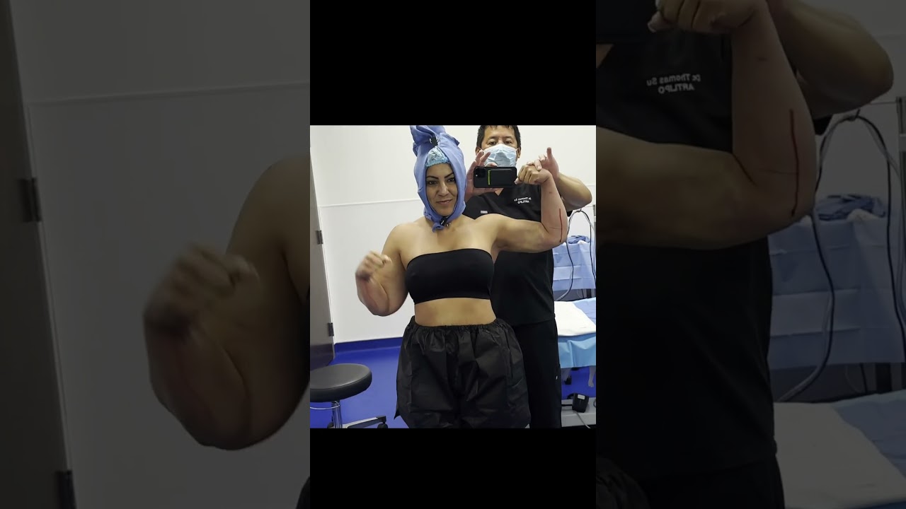 360&deg; Arm Liposuction | Celebrity Arms&trade; | Immediate Results | Expert Dr. Thomas Su | Artlipo