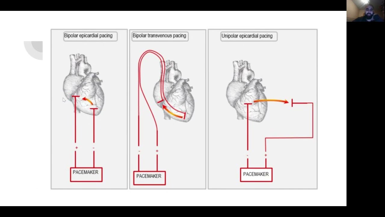 Arrhythmia and Pacing in Cardiac Surgery