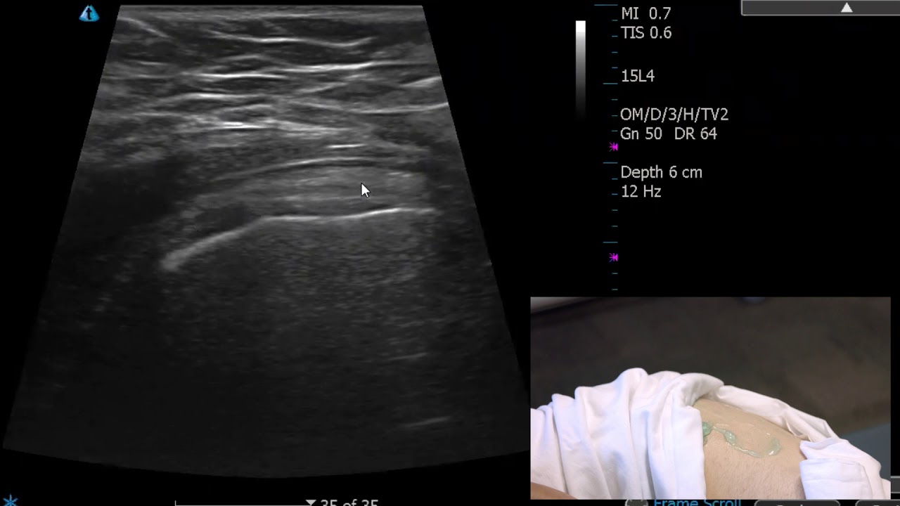 Hip   Lateral Exam