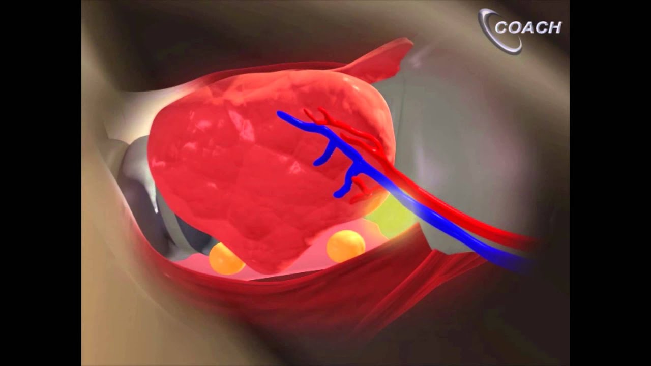 Minimally Invasive Total Thyroidectomy Video