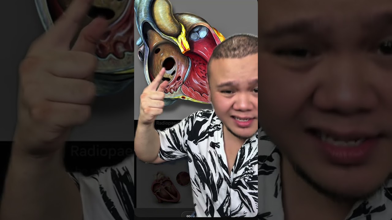 KENAPA SAMPAI KENA GUGURKAN KANDUNGAN? PERNAH DENGAR EDWARD SYNDROME?
