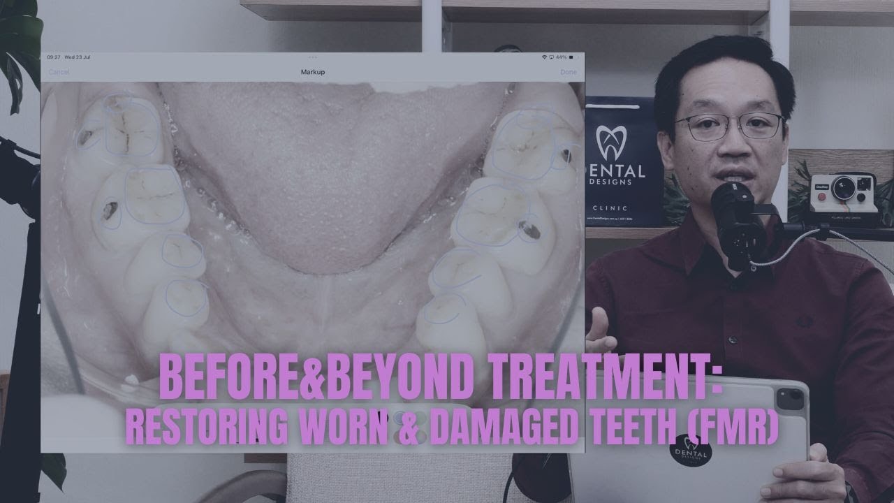 Full Mouth Rehabilitation Explained: How We Restore Worn & Damaged Teeth | BEFORE & BEYOND EP22