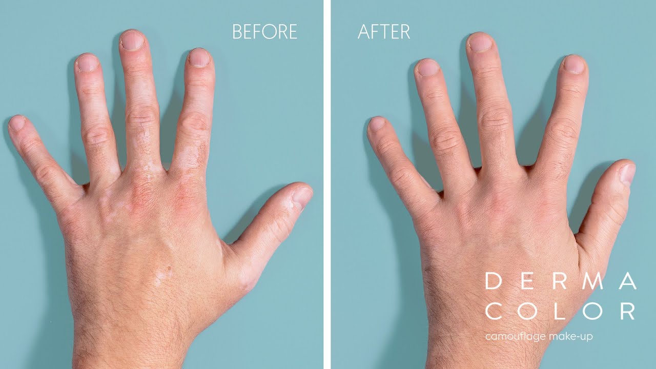 How To Cover Vitiligo On Hands With Dermacolor
