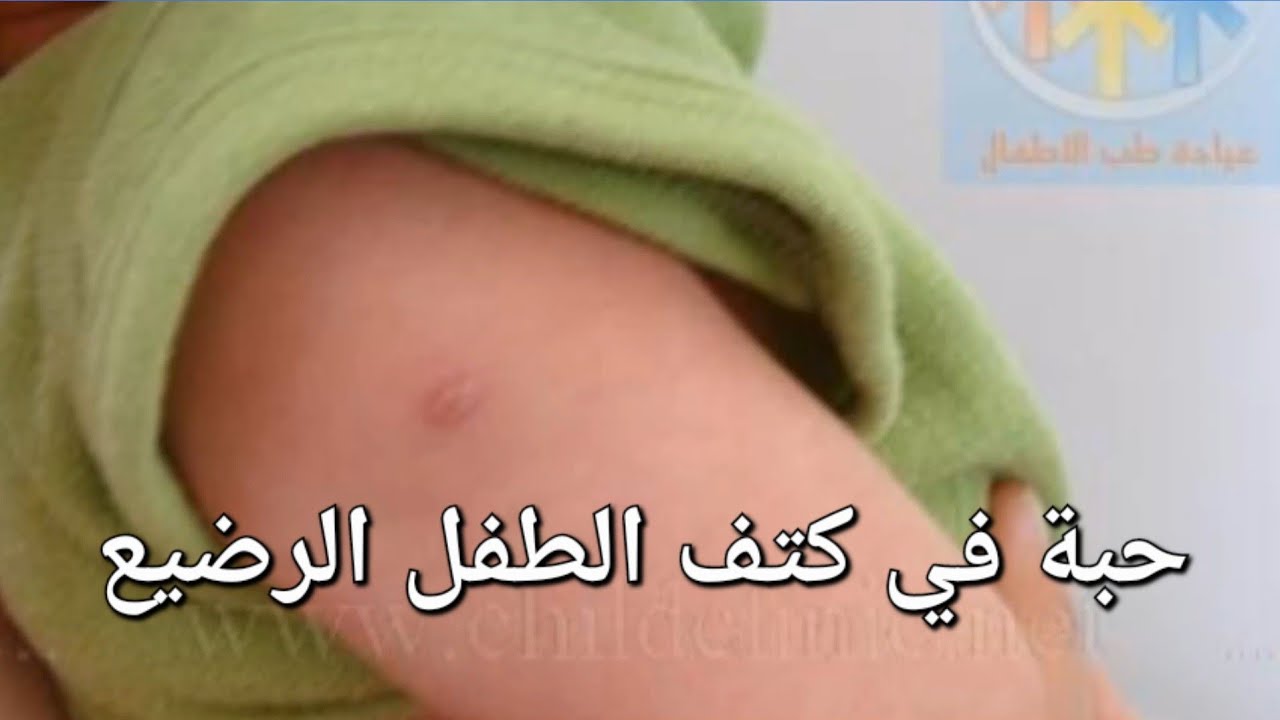 حبة في كتف الطفل الرضيع