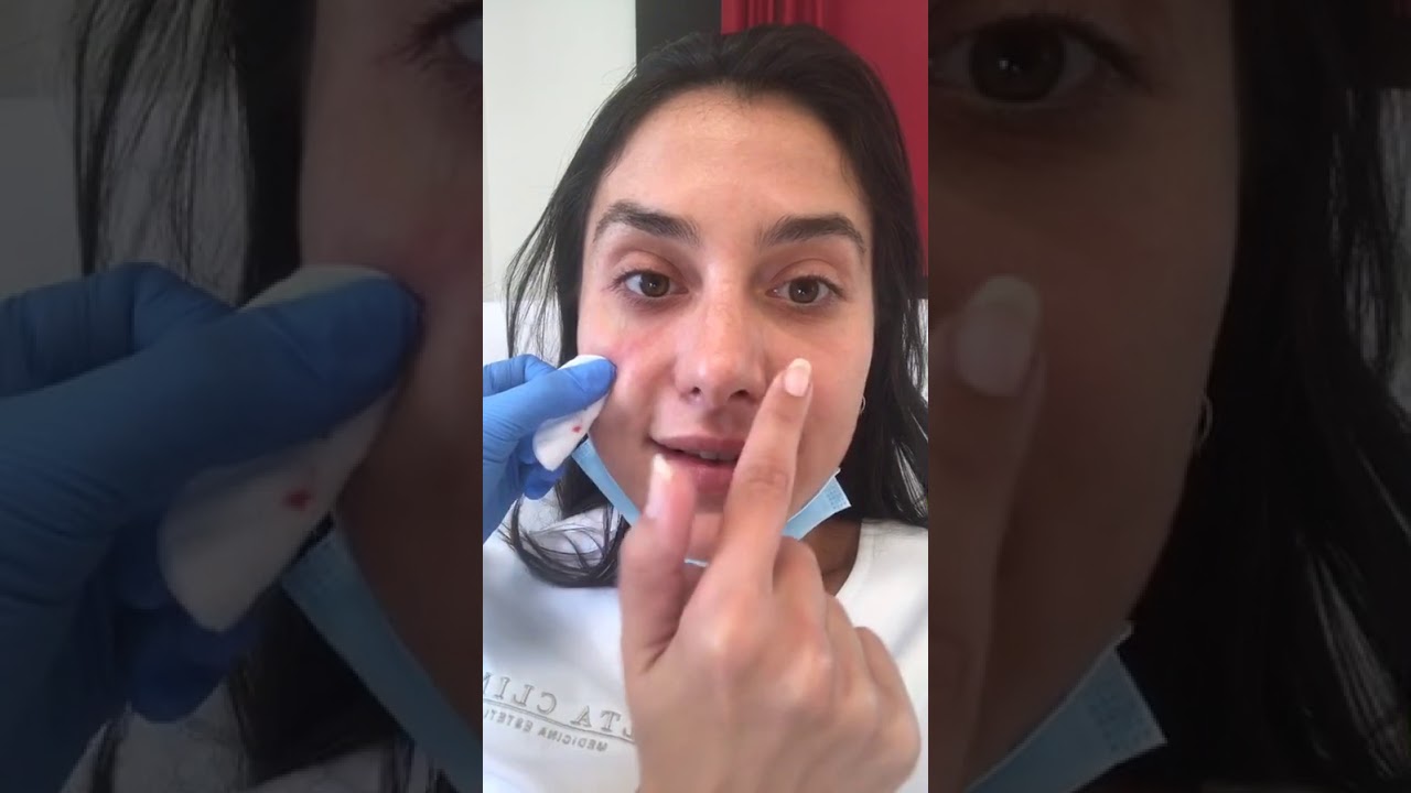 BIORIVITALIZZAZIONE SCHIARENTE OCCHIAIE