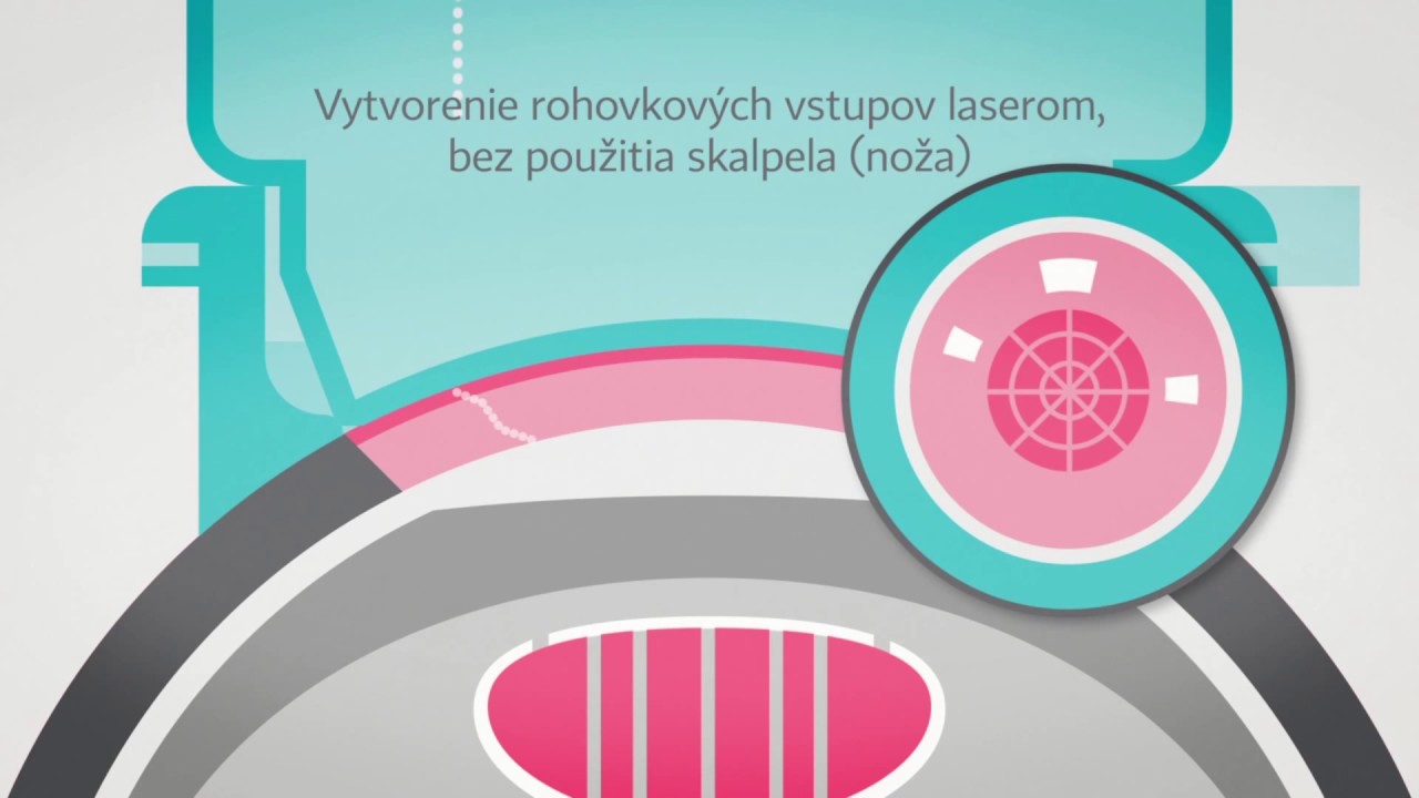 Sivý zákal (katarakta) | priebeh operácie