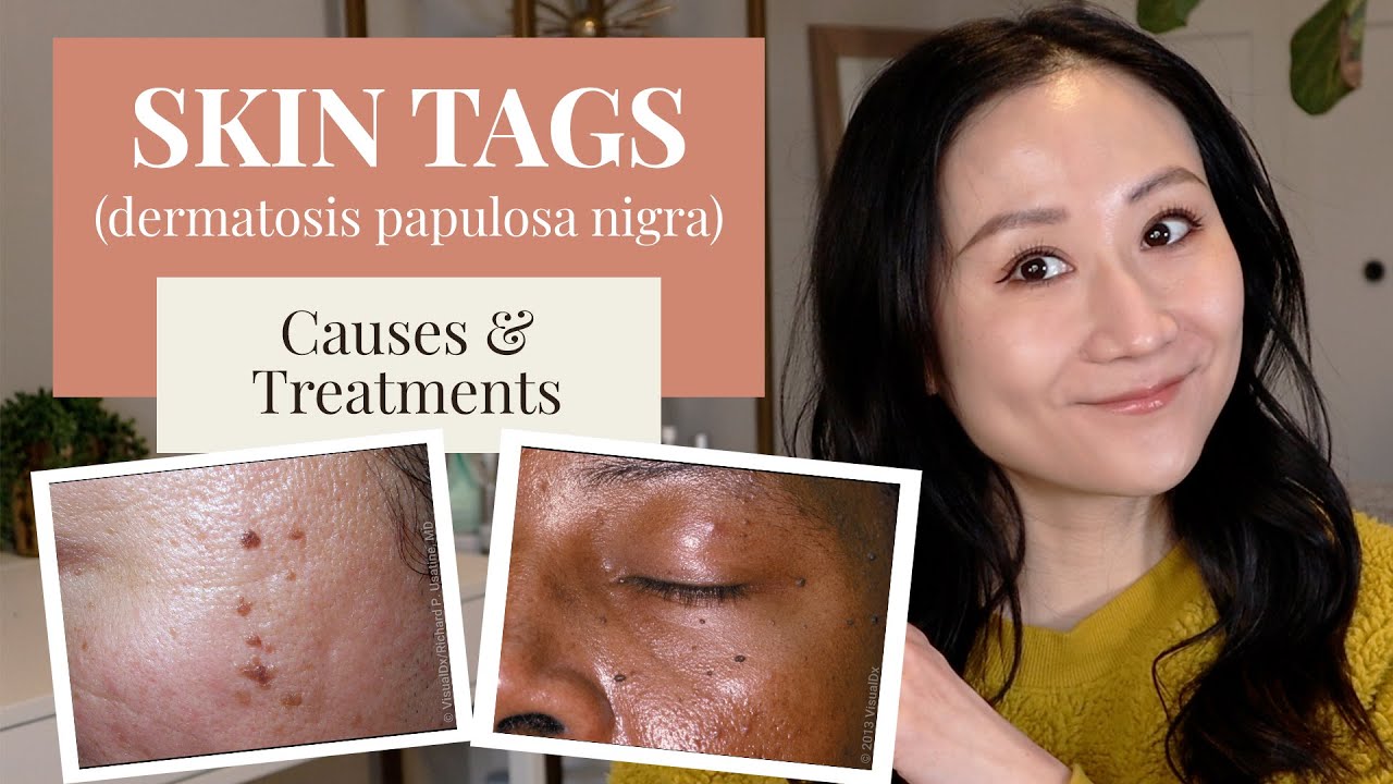 Skin Tags - Are They Dangerous? And How to Remove Them | Dermatologist Tips