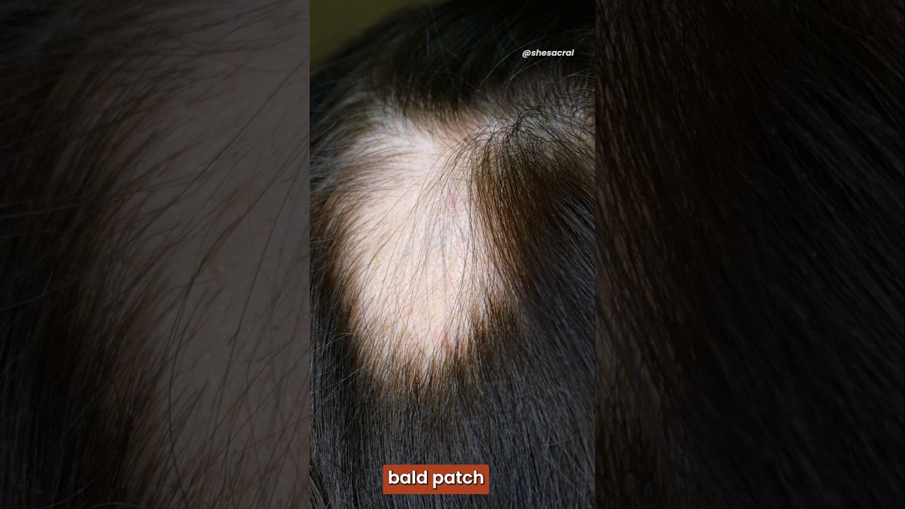 how stress causes hair loss
