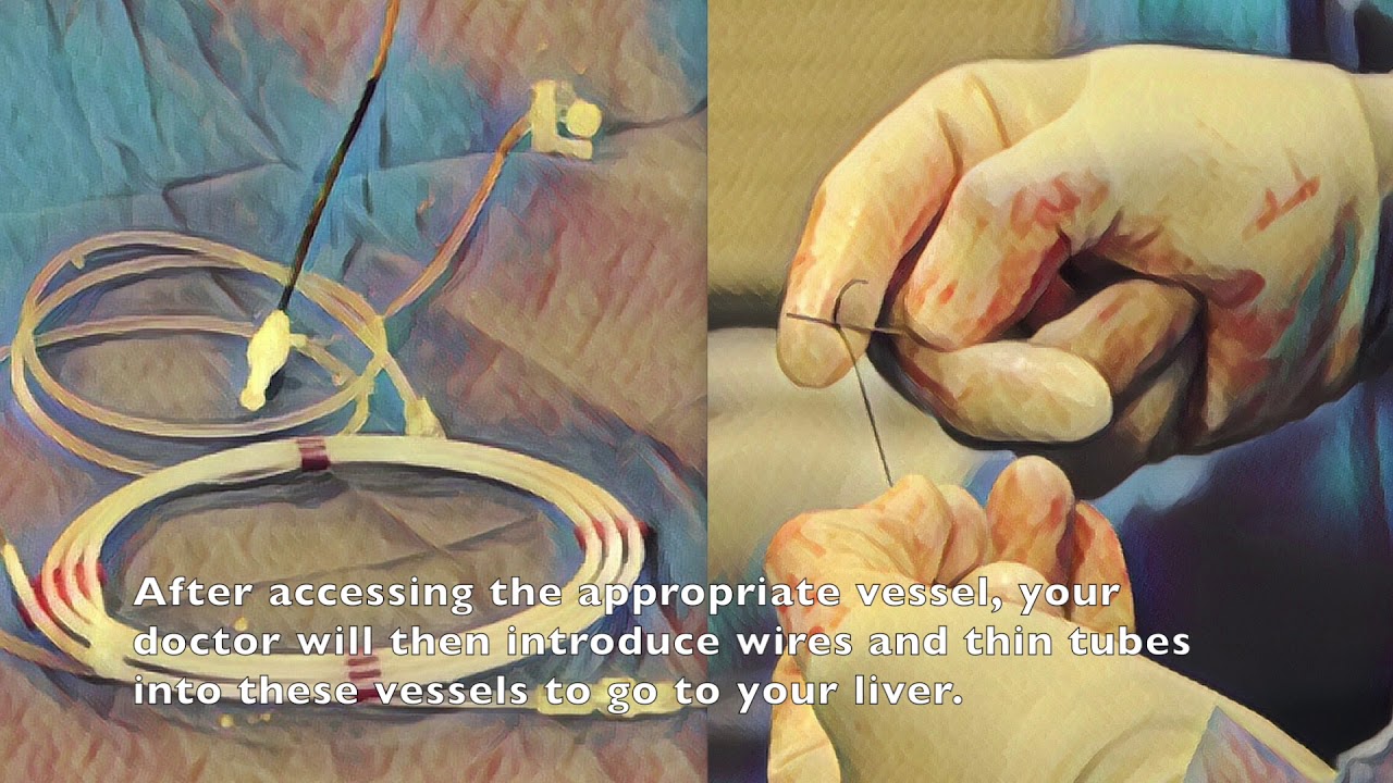 Y-90 Radioembolization Workup & Treatment