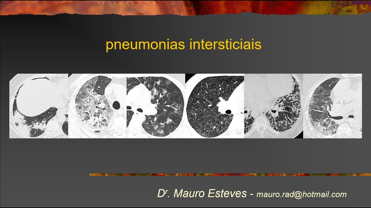Pneumonias intersticiais