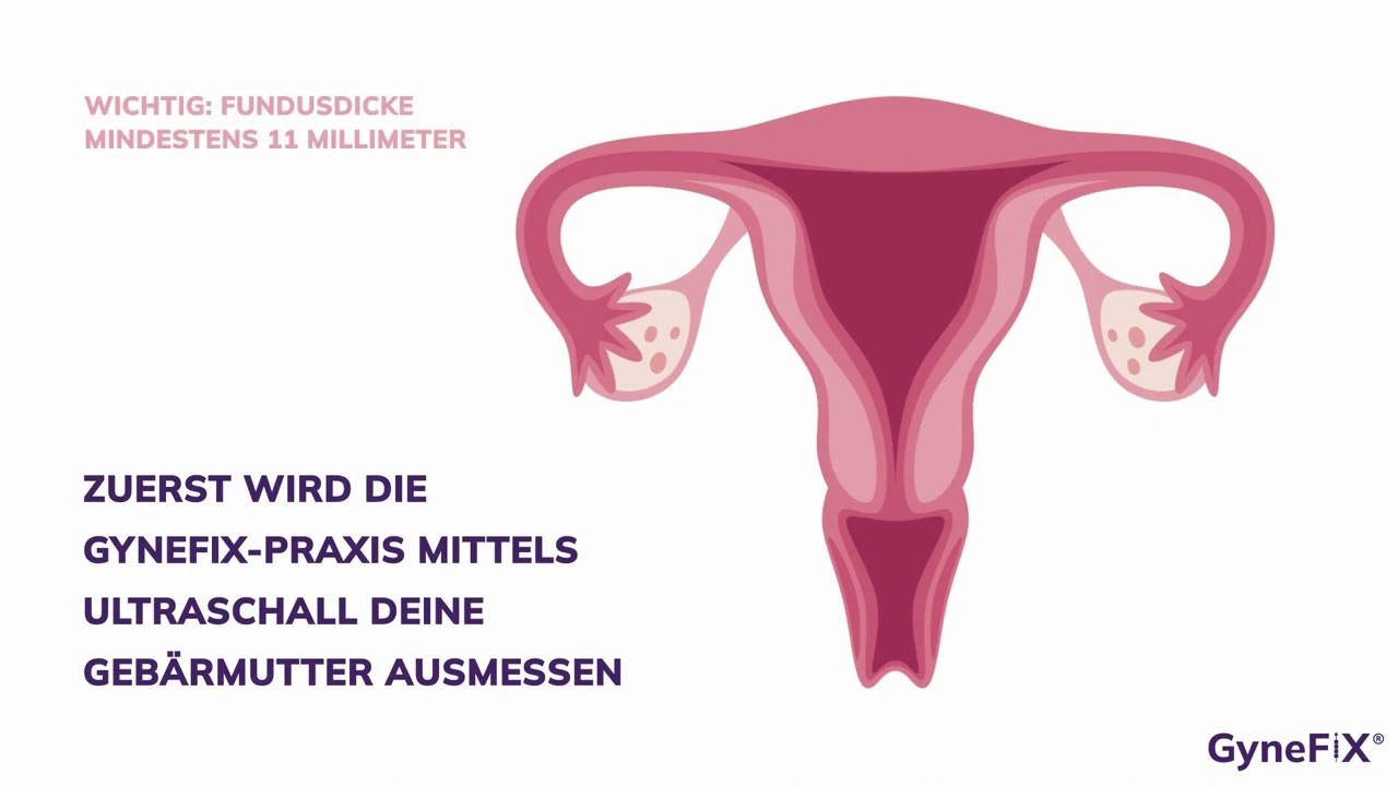 Kupferkette GyneFix® als hormonfreie Verhütung in Berlin-Frauenärzte am Potsdamer Platz