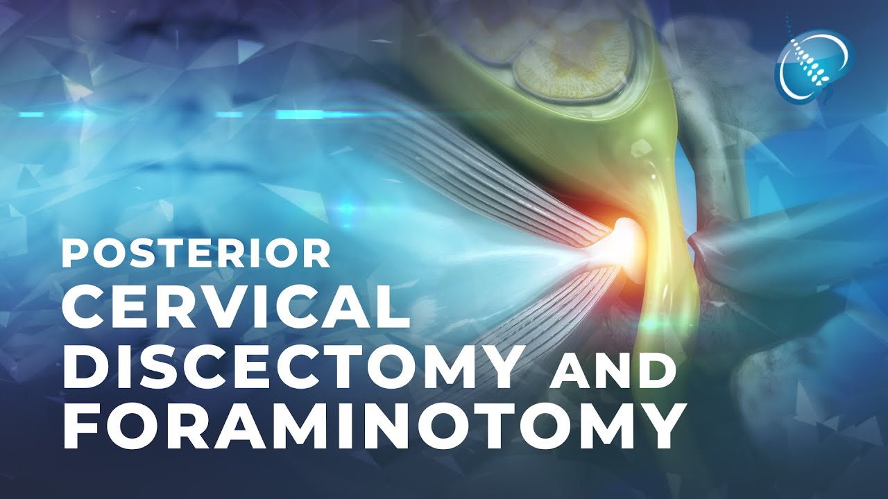 What is Endoscopic Posterior Cervical Discectomy and Foraminotomy?