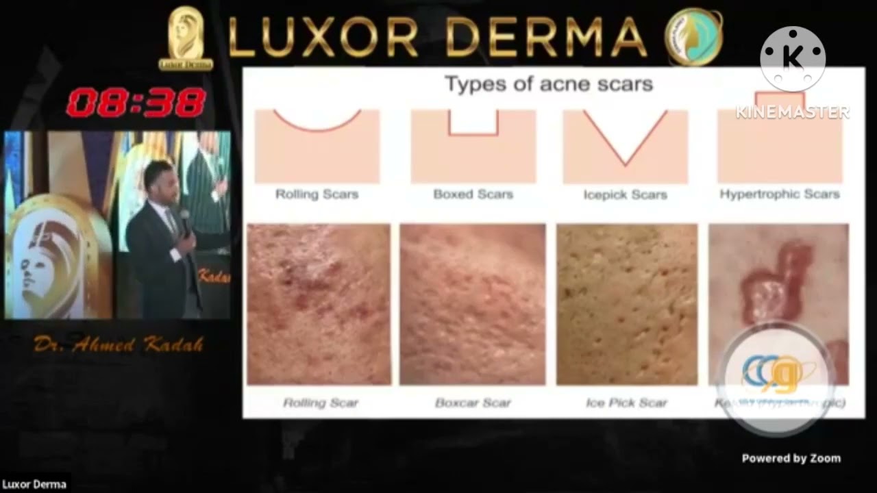 Acne & Rosacea by Dr Ahmed kadah
