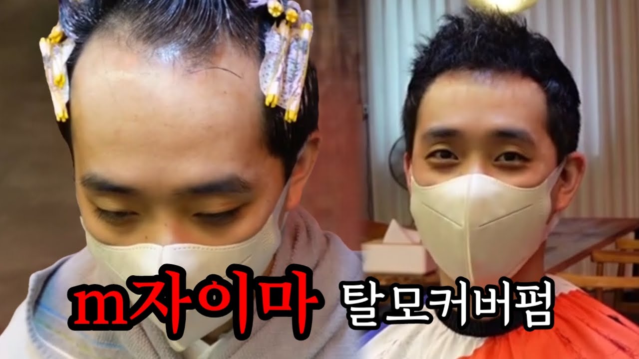 남자 m자 탈모펌 넓은 이마 엠자커버 탈모파마