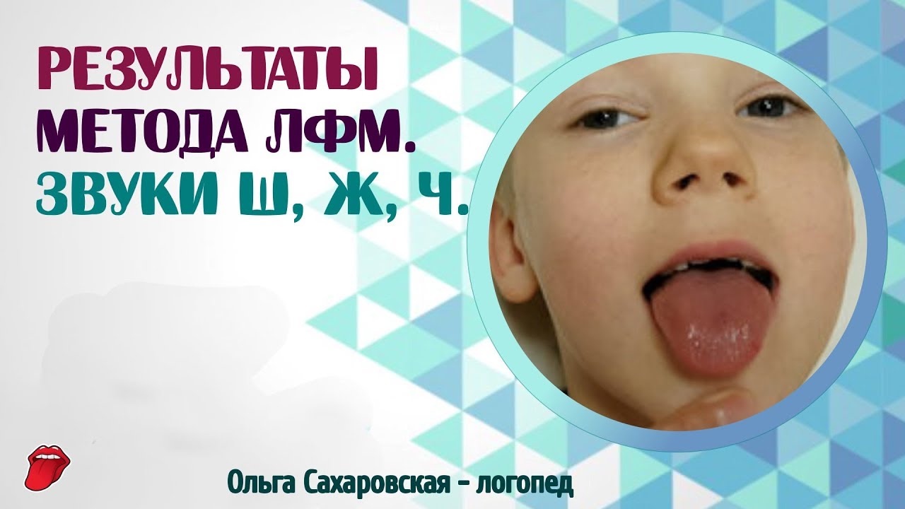 Паретическая форма дизартрии. Результаты Метода ЛФМ. Звуки Ш, Ж, Ч
