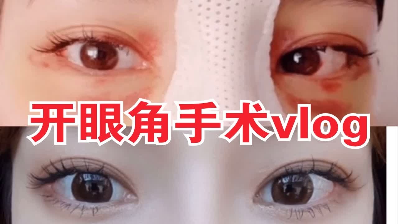 开眼角手术vlog，拥有卡姿兰大眼睛？