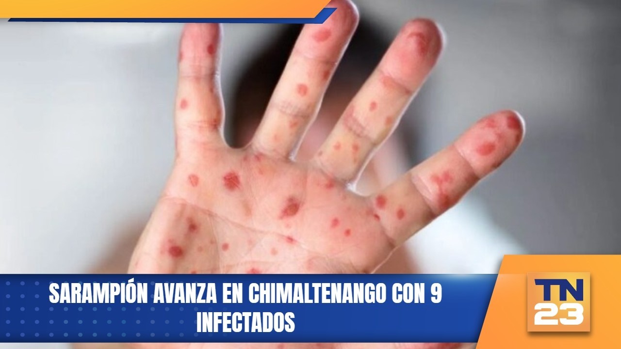 Sarampión avanza en Chimaltenango con 9 infectados